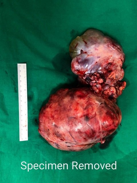 Apex Superspeciality Hospitals doctors remove 3 Kg tumour from chest after 6 hours of surgery