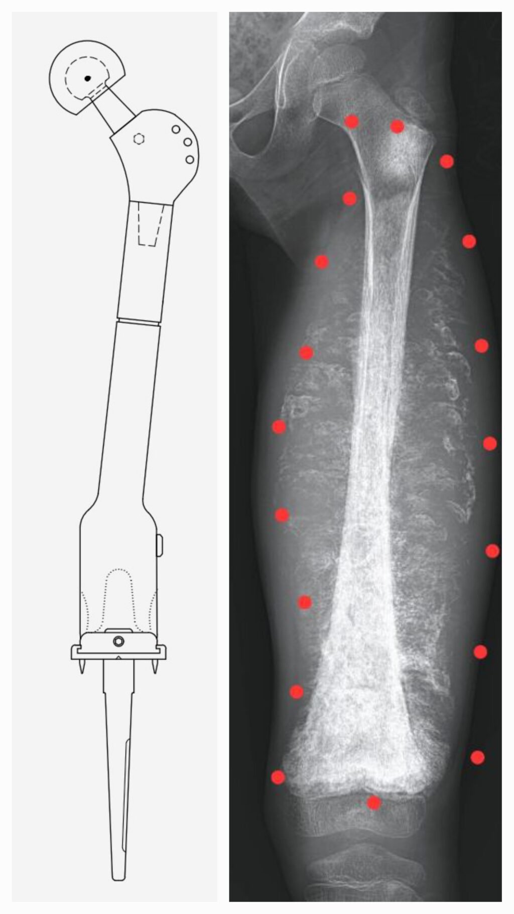 Apollo Cancer Centres, performed a unique and complex limb salvage surgery to treat a case of Osteosarcoma to remove cancer and reconstruct with custom growing prosthesis in the left thigh